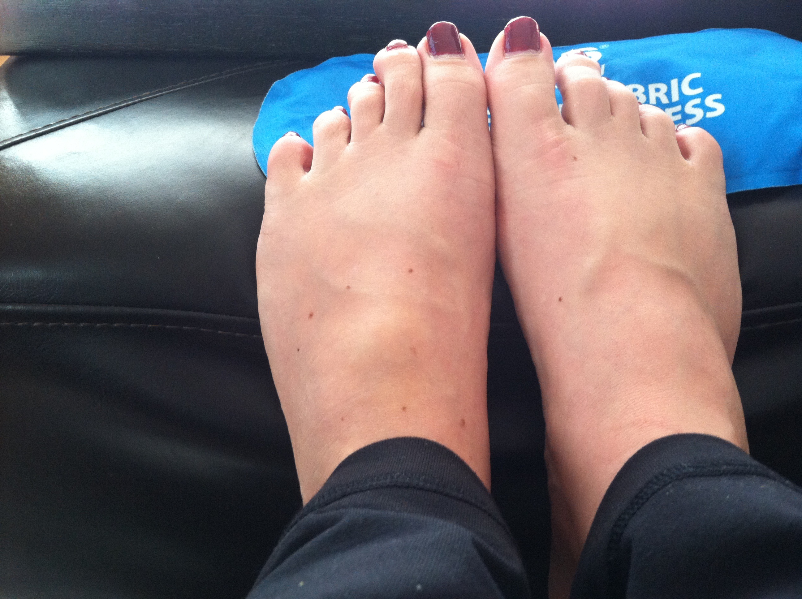 Foot Issues Married And Marathoning